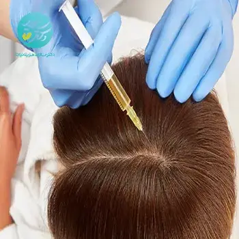 مزوتراپی مو