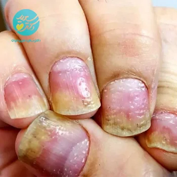 پکیج انواع مشکلات ناخن