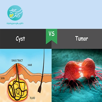 قرص کمک درمان تومورها و کیست ها
