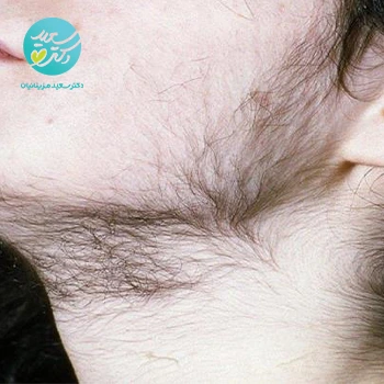 پکیج درمان پرمویی