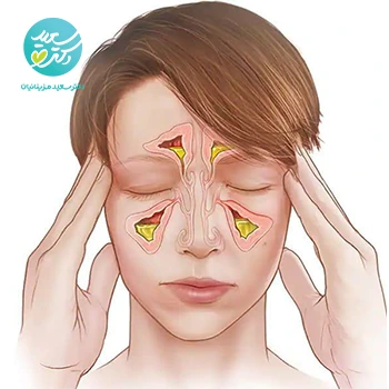 پکیج سینوزیت(قرص سرماخوردگی و عفونت- روغن سینوزیت)
