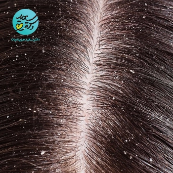 پکیج شوره سر