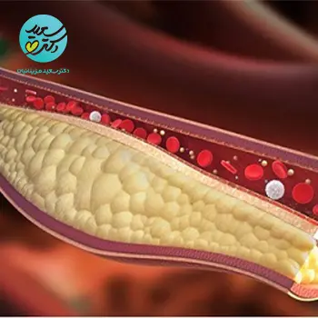 قرص ترکیبی کاهش تری گلسیرید یا چربی خون