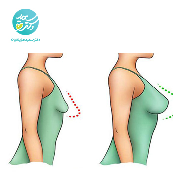 پکیج بزرگ کننده سینه