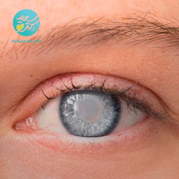 پکیج آب مروارید