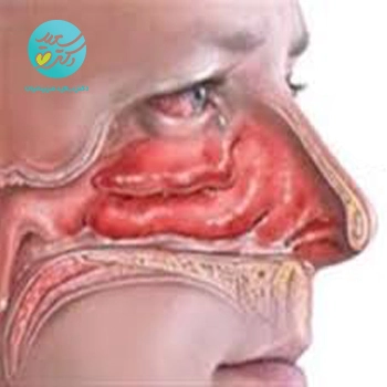 پکیج آلرژی(بینی)