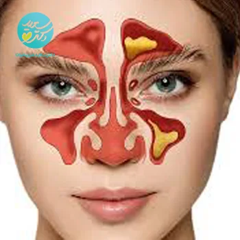 پکیج سینوزیت