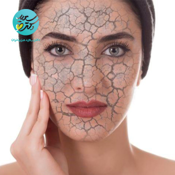 پکیج خشکی پوست صورت