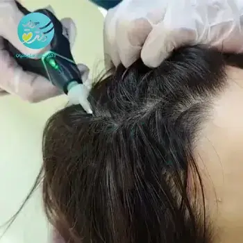 کربوکسی تراپی مو برای رفع ریزش و رویش مجدد مو