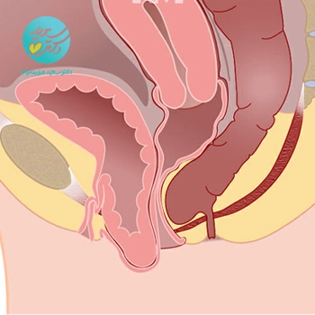 پکیج  افتادگی مثانه و رحم  (بی اختیاری ادرار)