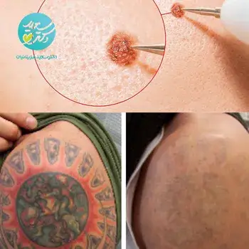 برداشتن خال و تتو بزرگ