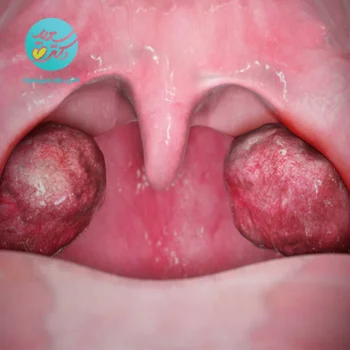 پکیج لوزه بزرگ