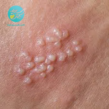 پکیج تبخال تناسلی