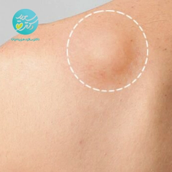 روغن ترکیبی لیپوم (غده چربی زیر پوستی)