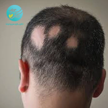 روغن آلوپسی(ریزش مو سکه ای)