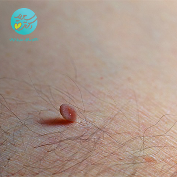 پماد زگیل، میخچه و خال گوشتی